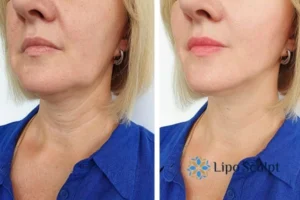 Double chin before and after Hi-Fu treatment 4 Book your double chin treatment Maidenhead today! We are here to help!