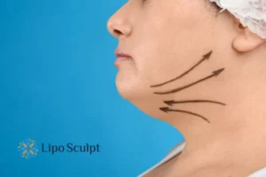 Double chin before and after Hi-Fu treatment 3 Boost your confidence with a Double chin treatment Maidenhead