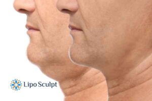 Double chin before and after Hi-Fu treatment 2 Double chin treatment Maidenhead from Lipo Sculpt - feel more confident today!