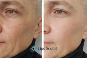 How to Fight Aging Symptoms 3 Fight Aging Symptoms Maidenhead With HIFU and Morpheus8 Today!