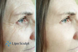 How to Fight Aging Symptoms 2 Do you want to Fight Aging Symptoms Maidenhead? Contact Lipo Sculpt today!