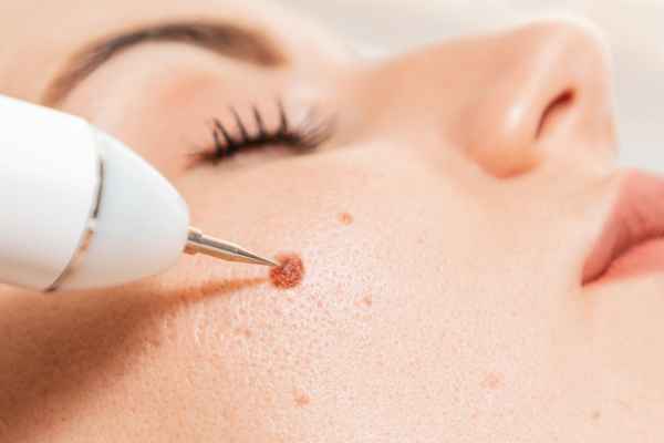 CryoPen: 5 Skin Concerns It May Be Used to Treat 3 What actually happens during a CryoPen treatment Maidenhead?