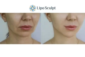 Explaining Total Skin Tightening Treatment And What It Can Do For You 2 Do you want to boost your self confidence? Give Morpheus8 Maidenhead a try today!