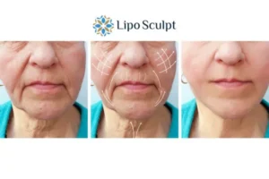 Explaining Total Skin Tightening Treatment And What It Can Do For You 3 Boost your confidence with Morpheus8 Maidenhead call our team today!