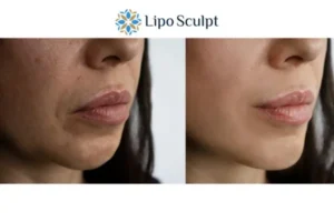 Explaining Total Skin Tightening Treatment And What It Can Do For You 4 Morpheus8 Maidenhead the best results - call our team today!