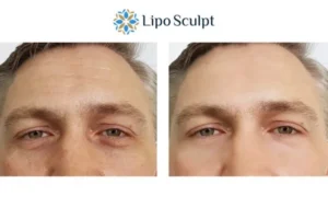 Explaining Total Skin Tightening Treatment And What It Can Do For You 6 Morpheus8 Maidenhead book in today to find out more!