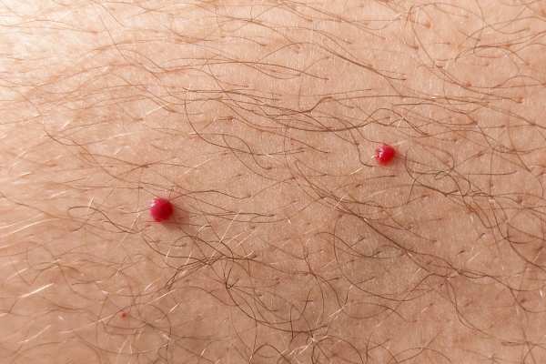CryoPen: 5 Skin Concerns It May Be Used to Treat 2 cherry angioma removal Maidenhead