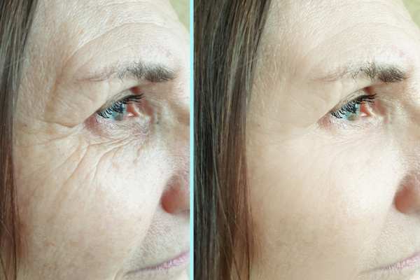 Why Do People Choose HIFU for a Non-Surgical Facelift? 4 How long can HIFU results last Maidenhead?
