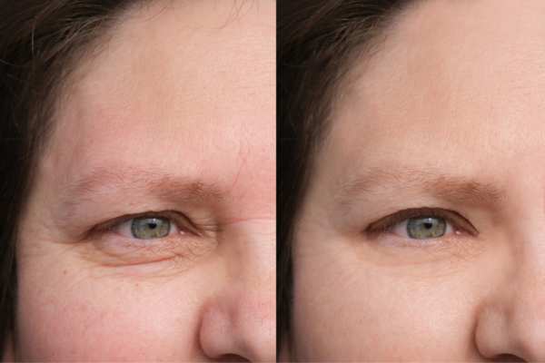 HIFU vs Botulinum Toxin: Understanding the Differences 4 How long do HIFU results last Maidenhead?