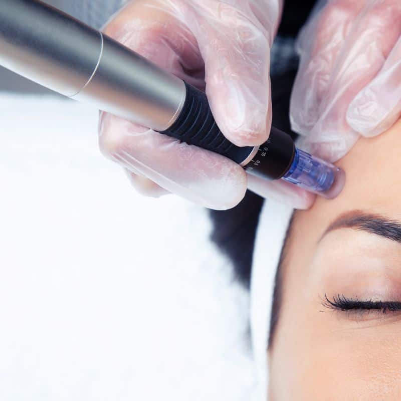 Morpheus8 treatment Maidenhead from Lipo Sculpt - Book in today!