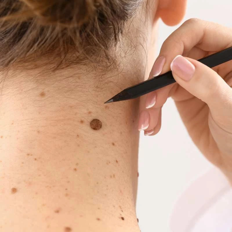 How to Support Your Body During Pregnancy for Faster Postnatal Recovery 5 See our lesion removal prices Maidenhead - call today for a free quote
