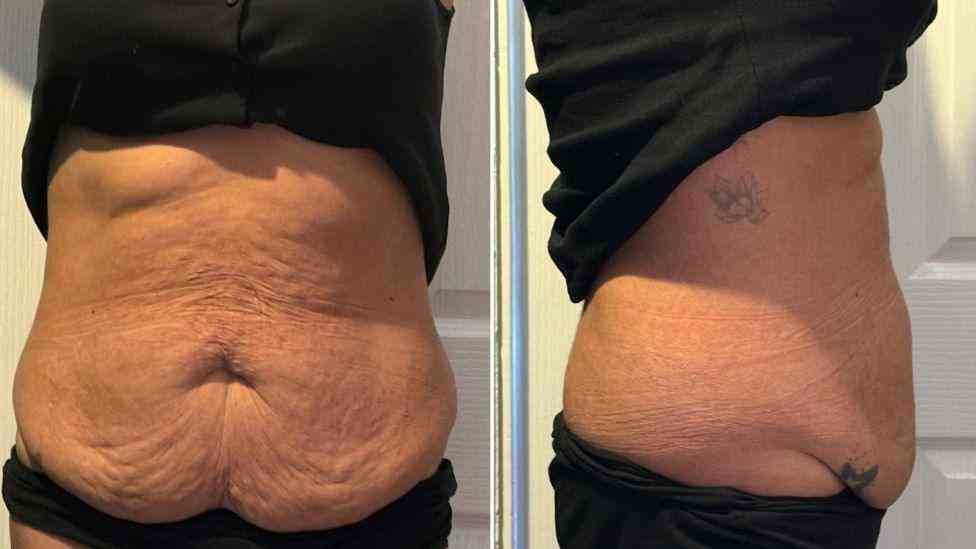 Lost the Weight but Not the Loose Skin? What You Should Know 1 Is It Definitely Loose Skin Maidenhead?