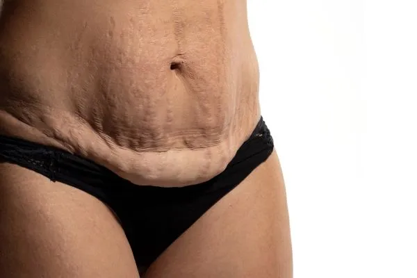 Lost the Weight but Not the Loose Skin? 1 image of womans stomach after weight loss showing loose skin Maidenhead